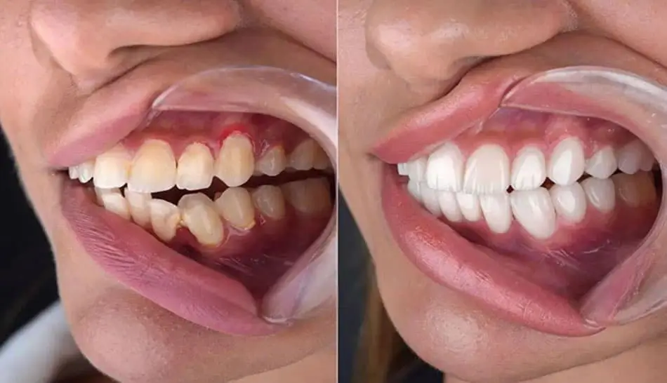 video treatment method for swollen gums with pus